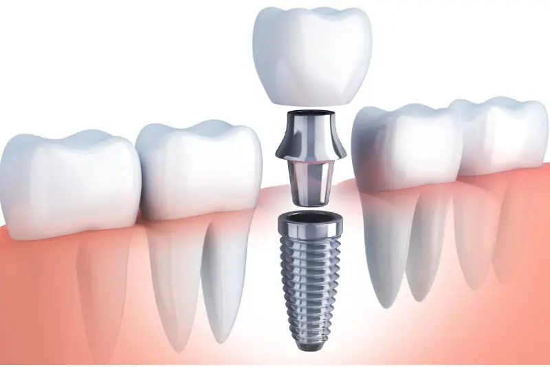 Implantes Dentales