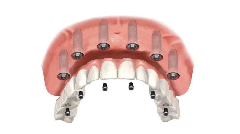 Implantes Dentales